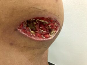 手術から二日後