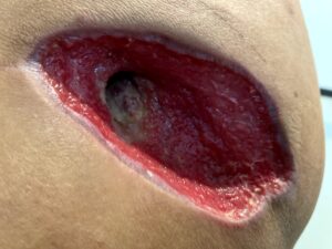 退院後二ヶ月経過時